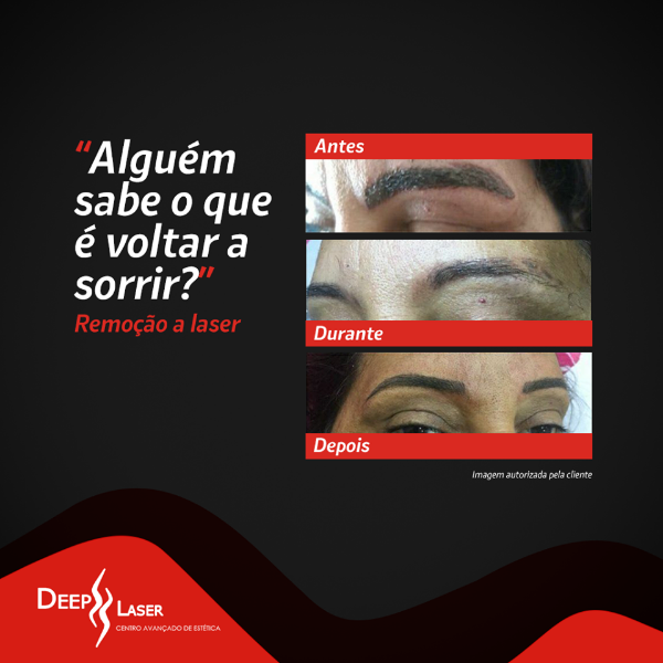 despigmentacao-de-micropigmentacao-de-sobrancelhas-a-laser