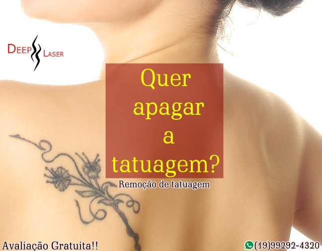 remocao-de-tatuagem