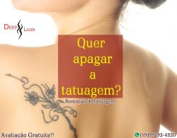 Remoção de Tatuagem