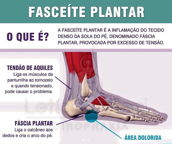 fascite-plantar-com-quiropraxia-ipeuna-saltinho-aguas-de-sao-pedro