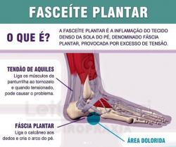 Fascite plantar com Quiropraxia 