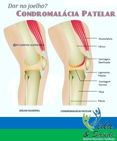 condromalacia-patelar-botucatu-jau-iracemapolis