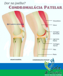 Saúde e beleza - Condromalacia patelar - Condromalacia patelar