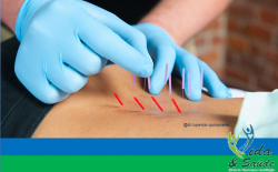 Dry Needling 