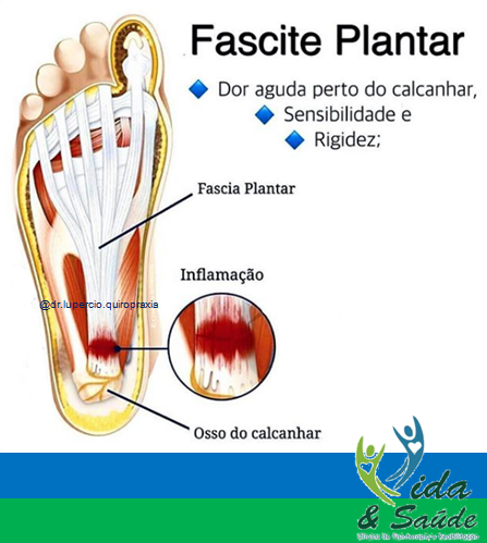 fascite-plantar-itapetininga-botucatu-jau