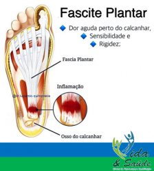 Fascite Plantar 