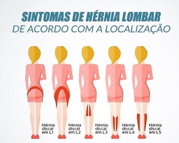 hernia-lombar-limeira-iracemapolis-santa-barbara