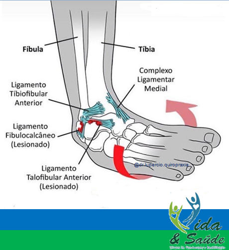 entorse-de-tornozelo-bauru-itapetininga-botucatu-jau