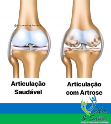 Saúde e beleza - Tratamento para Artrose - Tratamento para Artrose