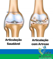 Tratamento para Artrose