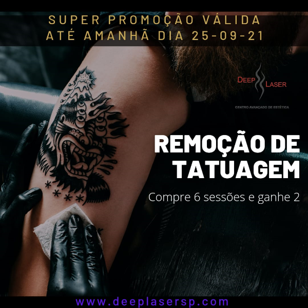 remocao-de-tatuagem-a-laser-