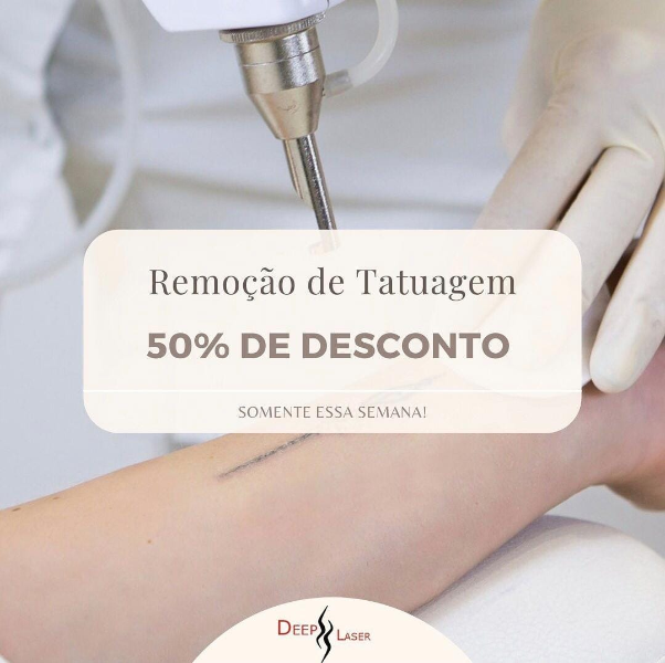 remocao-de-tatuagem