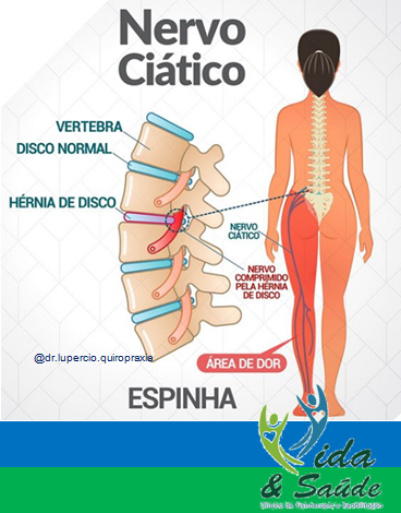 nervo-ciatico-jau-limeira-iracemapolis