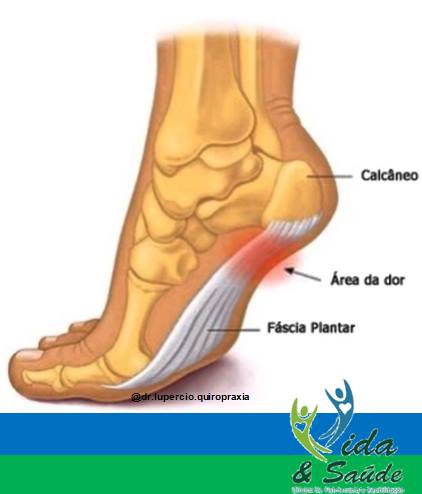 fascite-plantar-sao-pedro-charqueada-ipeuna