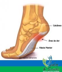 FASCITE PLANTAR 