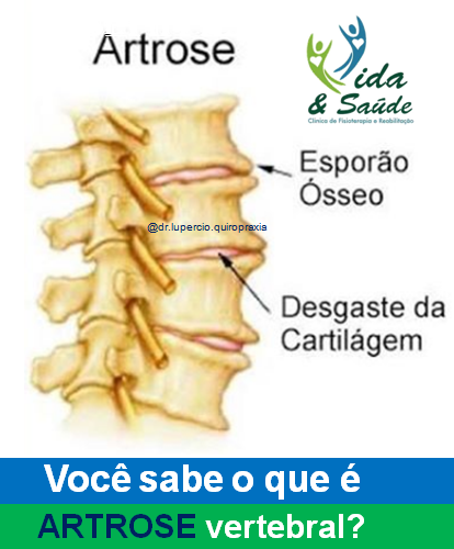 artrose-vertebral-aguas-de-sao-pedro-campinas-rio-das-pedras-