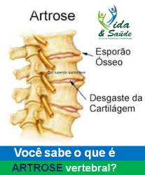 ARTROSE VERTEBRAL 