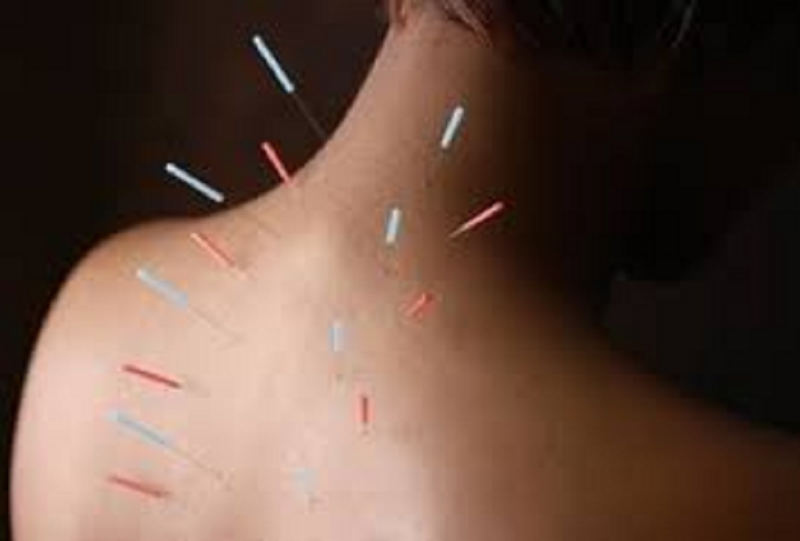 dry-needling-acupuntura-no-ponto-de-dor