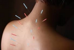 Dry needling Acupuntura no ponto de dor