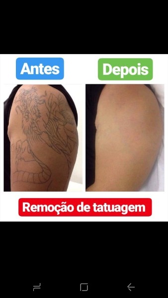 remocao-de-tatuagem-a-laser-jardins-sao-paulo