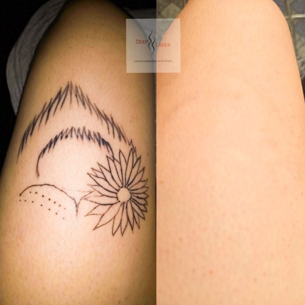 remocao-de-tatuagem-a-laser-jardins-sao-paulo-promocao-06-secoes-e-ganhe-2