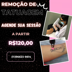 Remoção de Tatuagem a Laser - Jardins São Paulo Promoção 50 % OFF
