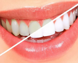 Saúde e beleza - CLAREAMENTO DENTAL A LASER - CLAREAMENTO DENTAL A LASER