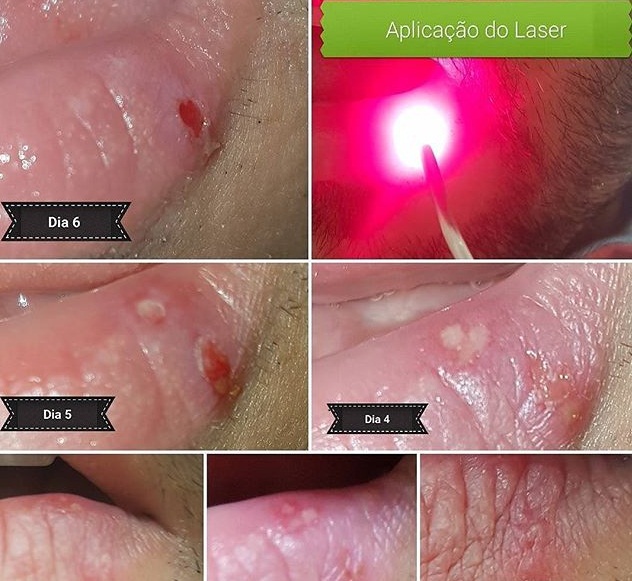 laserterapia-odontologico