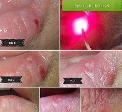laserterapia Odontológico