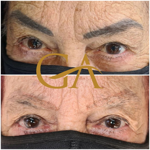 remocao-de-microblading-micropigmentacao-de-sobrancelhas-