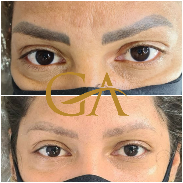 remocao-de-microblading-micropigmentacao-de-sobrancelhas-