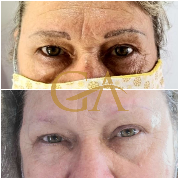 remocao-de-microblading-micropigmentacao-de-sobrancelhas-