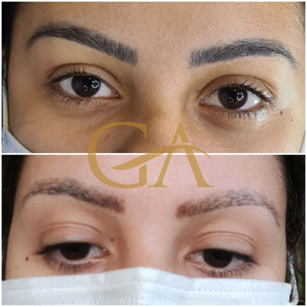 remocao-de-microblading-micropigmentacao-de-sobrancelhas-