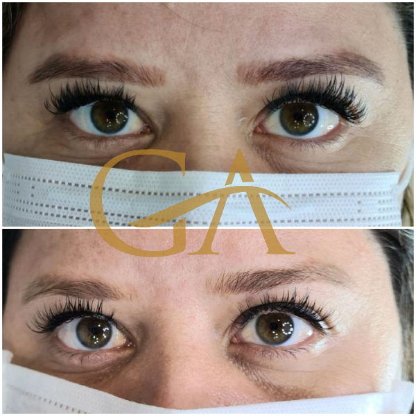 remocao-de-microblading-micropigmentacao-de-sobrancelhas-