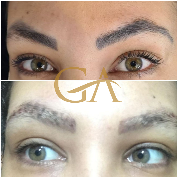 remocao-de-microblading-micropigmentacao-de-sobrancelhas-