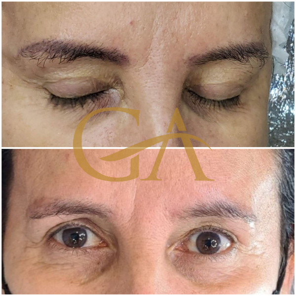 remocao-de-microblading-micropigmentacao-de-sobrancelhas-