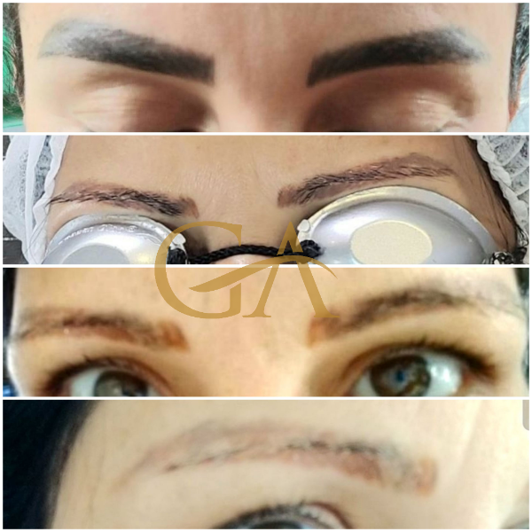 remocao-de-microblading-micropigmentacao-de-sobrancelhas-