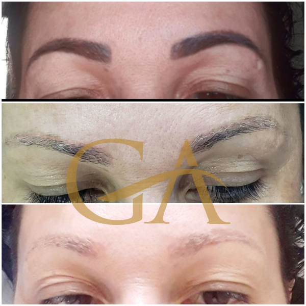 remocao-de-microblading-micropigmentacao-de-sobrancelhas-