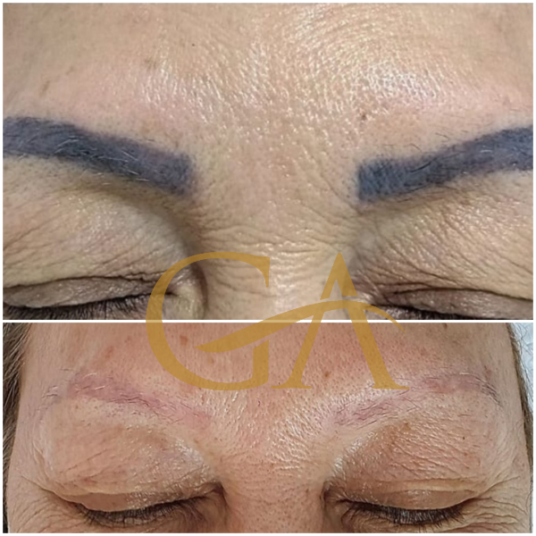 remocao-de-microblading-micropigmentacao-de-sobrancelhas-