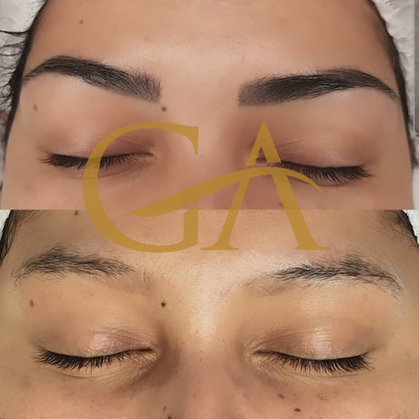 remocao-de-microblading-micropigmentacao-de-sobrancelhas-