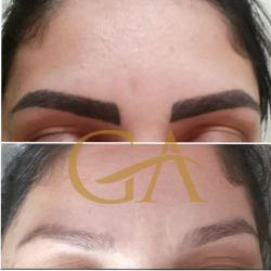 Remoção de microblading /micropigmentação de sobrancelhas 