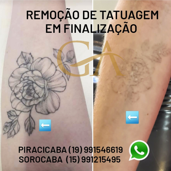 remocao-de-tatuagem-