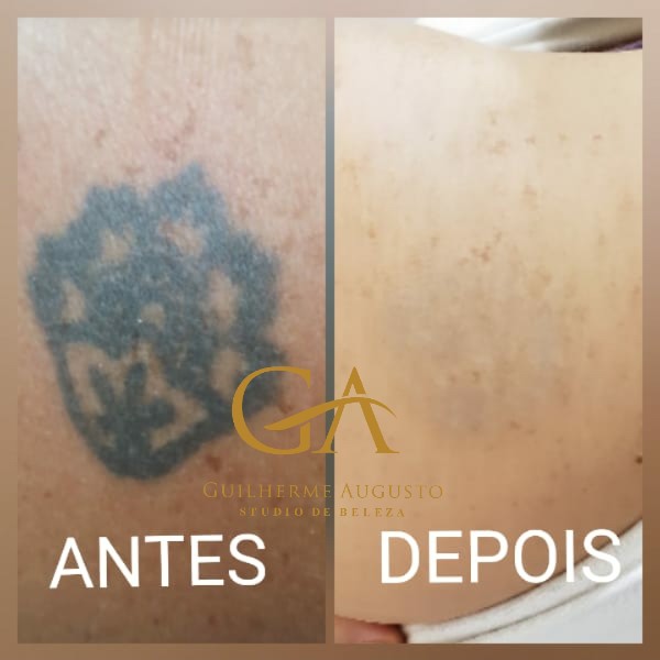 remocao-de-tatuagem-