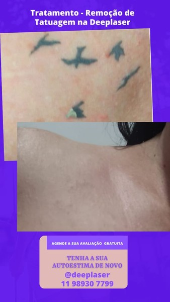 remocao-de-tatuagem-a-laser-piracicaba