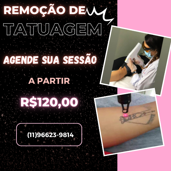 remocao-de-tatuagem-a-laser-