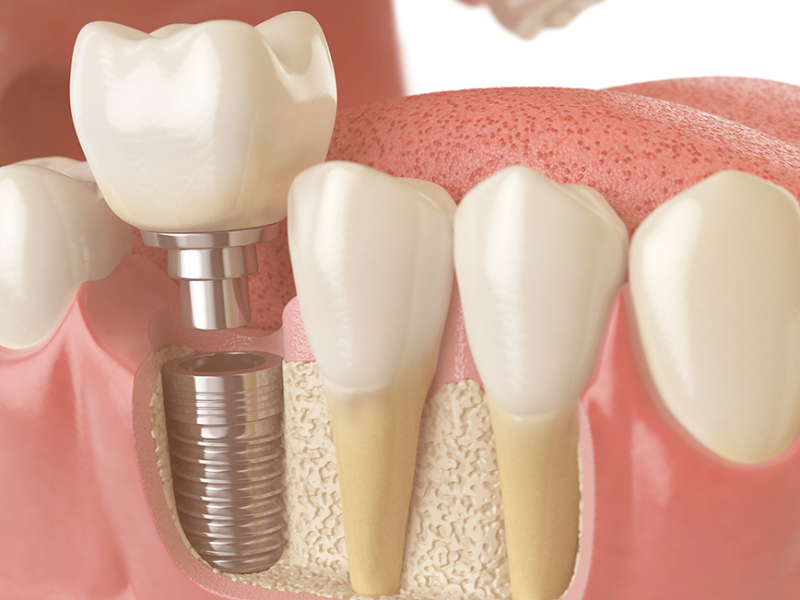 implante-de-dentes-em-sao-pedro-piracicaba