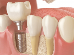 Implante de Dentes