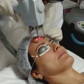 Tratamento de Pele com CO2 Laser