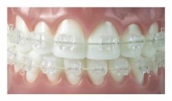 Saúde e beleza - Aparelho Odontológico Estético Piracicaba - Aparelho Odontológico Estético Piracicaba