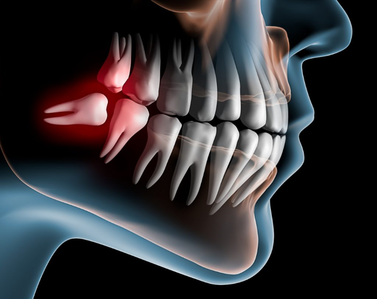 cirurgia-do-siso